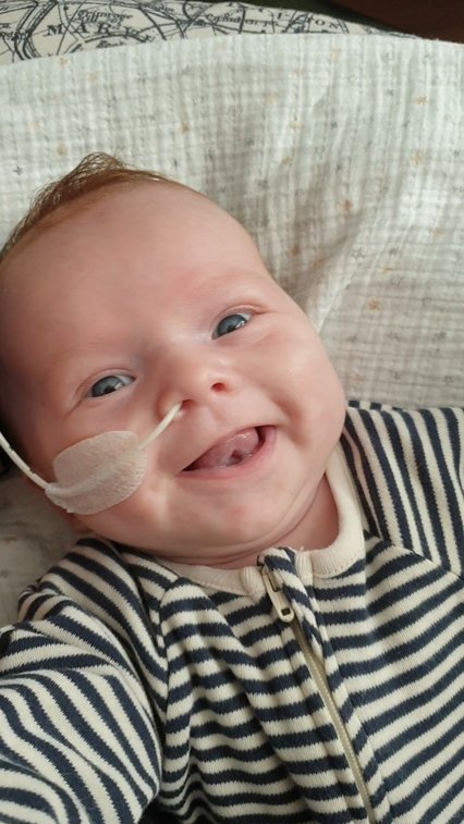 a smiley baby with mitochondrial disease with a feeding tube in their nose