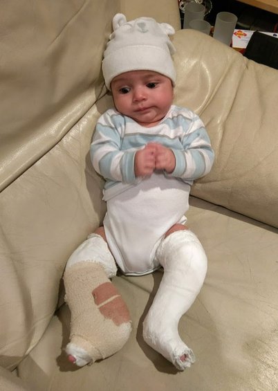 A small baby in a white baby grow with plaster casts on their legs